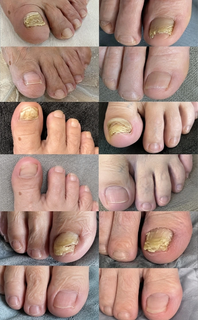 Five of the 180 who carried on to twelve weeks. Day 1 above, week 12 below.