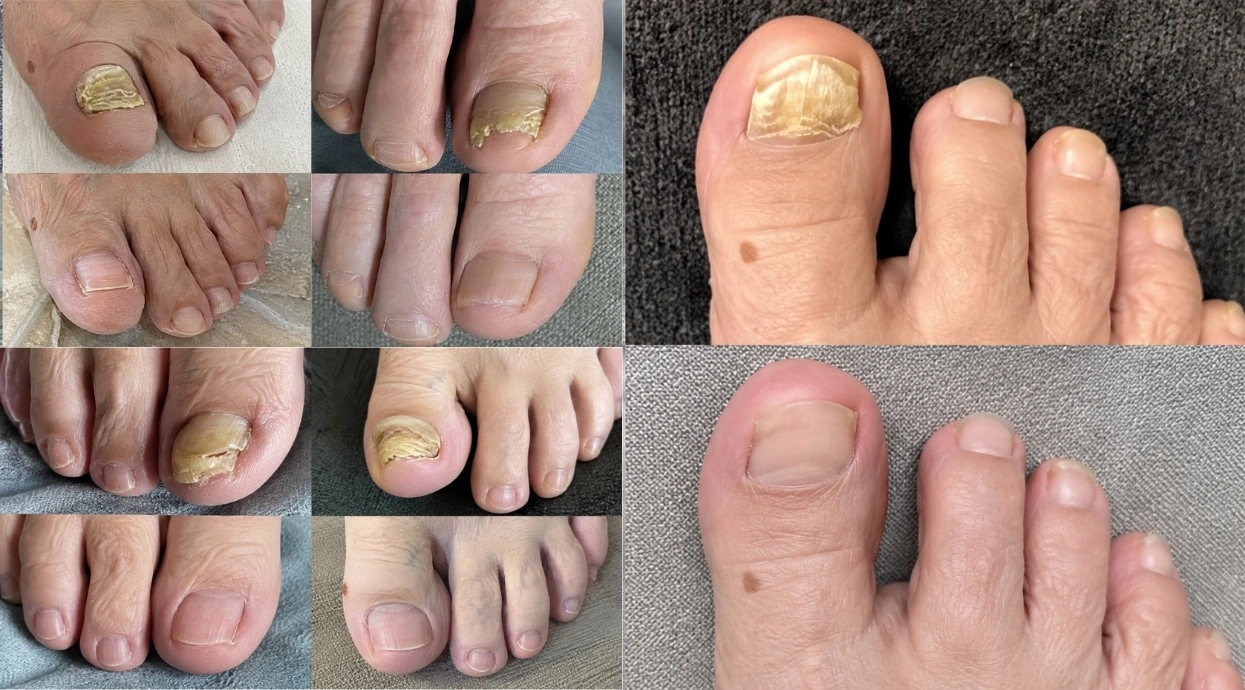 A photo collage comparing unhealthy, yellowed toenails with clear, healthy-looking toenails.