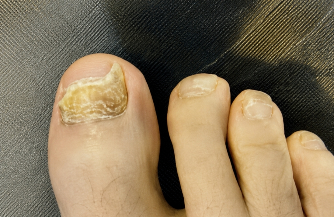 A close-up of a person's foot, with a thick, yellow, and crumbling nail on the big toe.