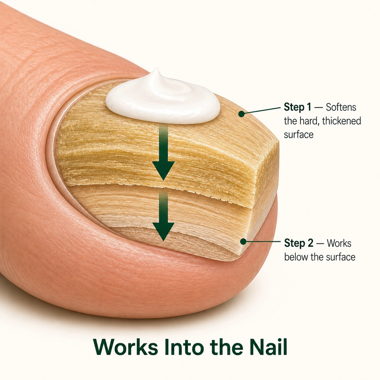 A diagram showing a cream applied to a toenail cross-section, with arrows indicating penetration into nail layers.