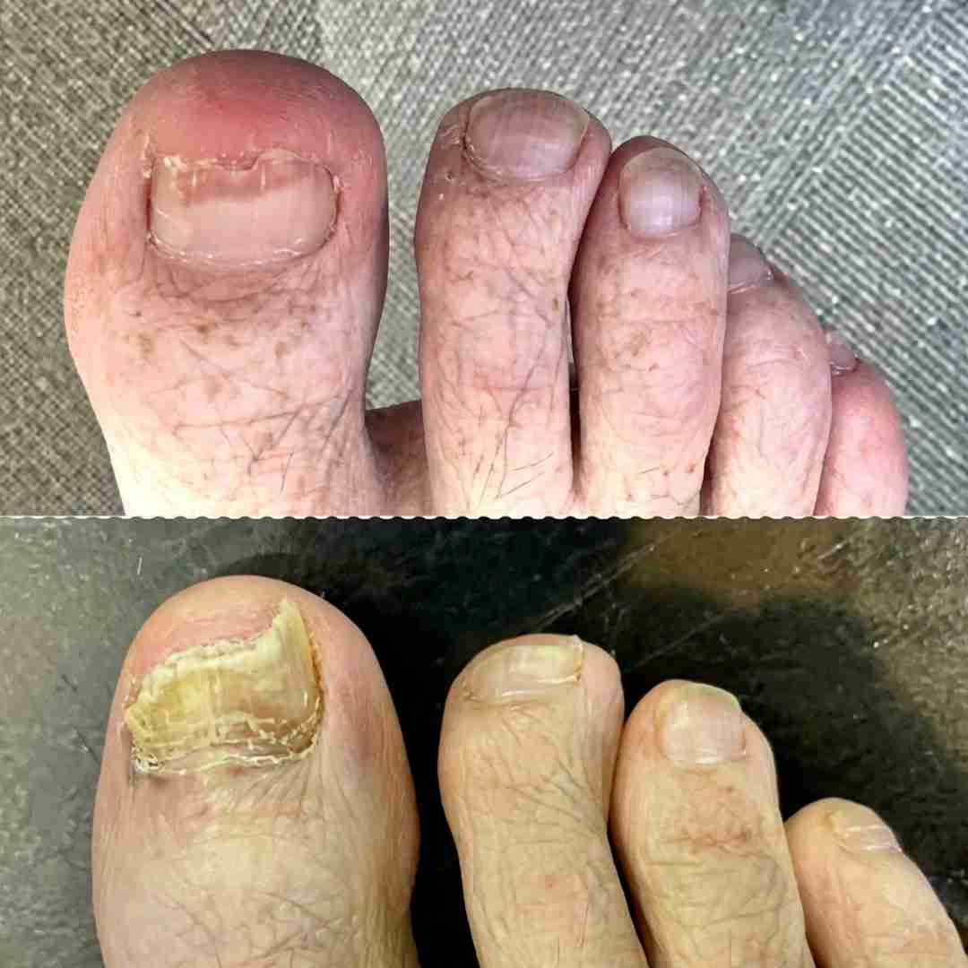A split-image comparison of a big toenail, showing a healthier state above and a damaged, yellowed state below.