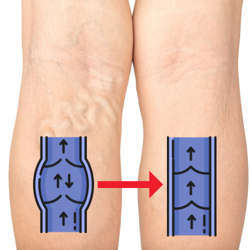 Close-up of legs with varicose veins and diagram showing vein improvement.