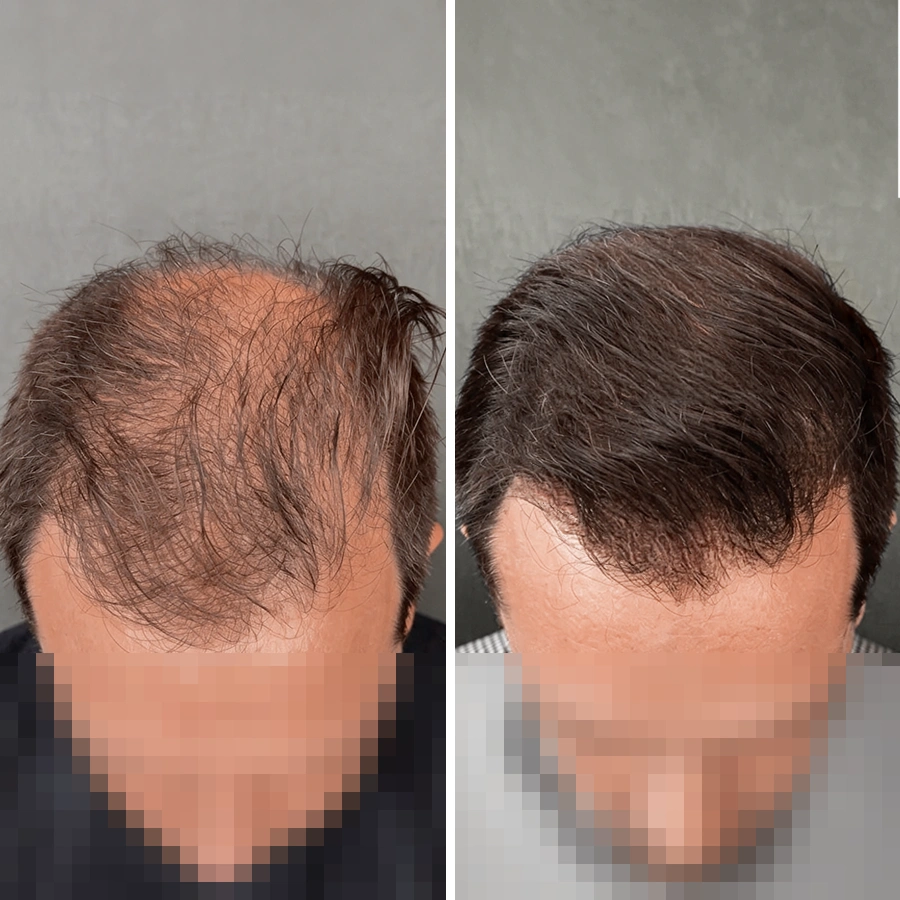 Thomas - avant/après