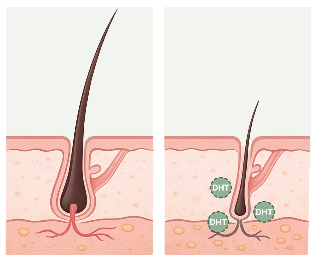 La DHT miniaturise vos follicules