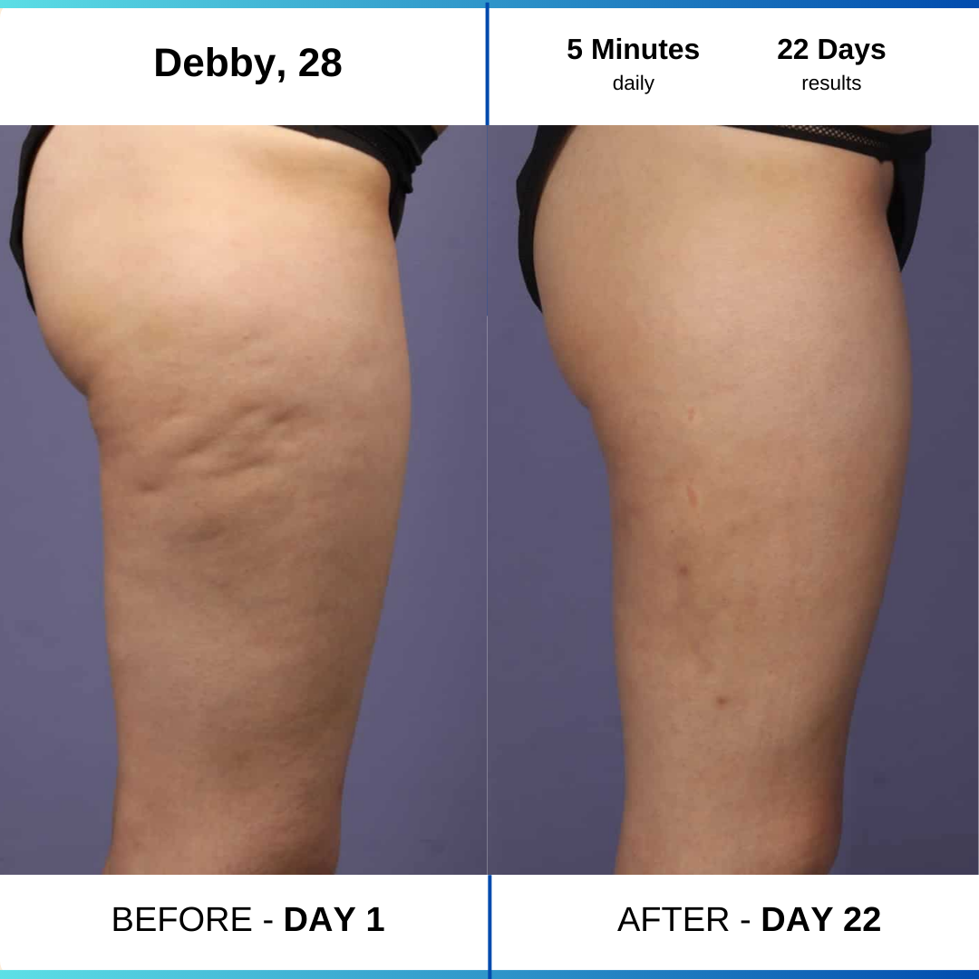 Side-by-side comparison of a leg before and after 22 days.