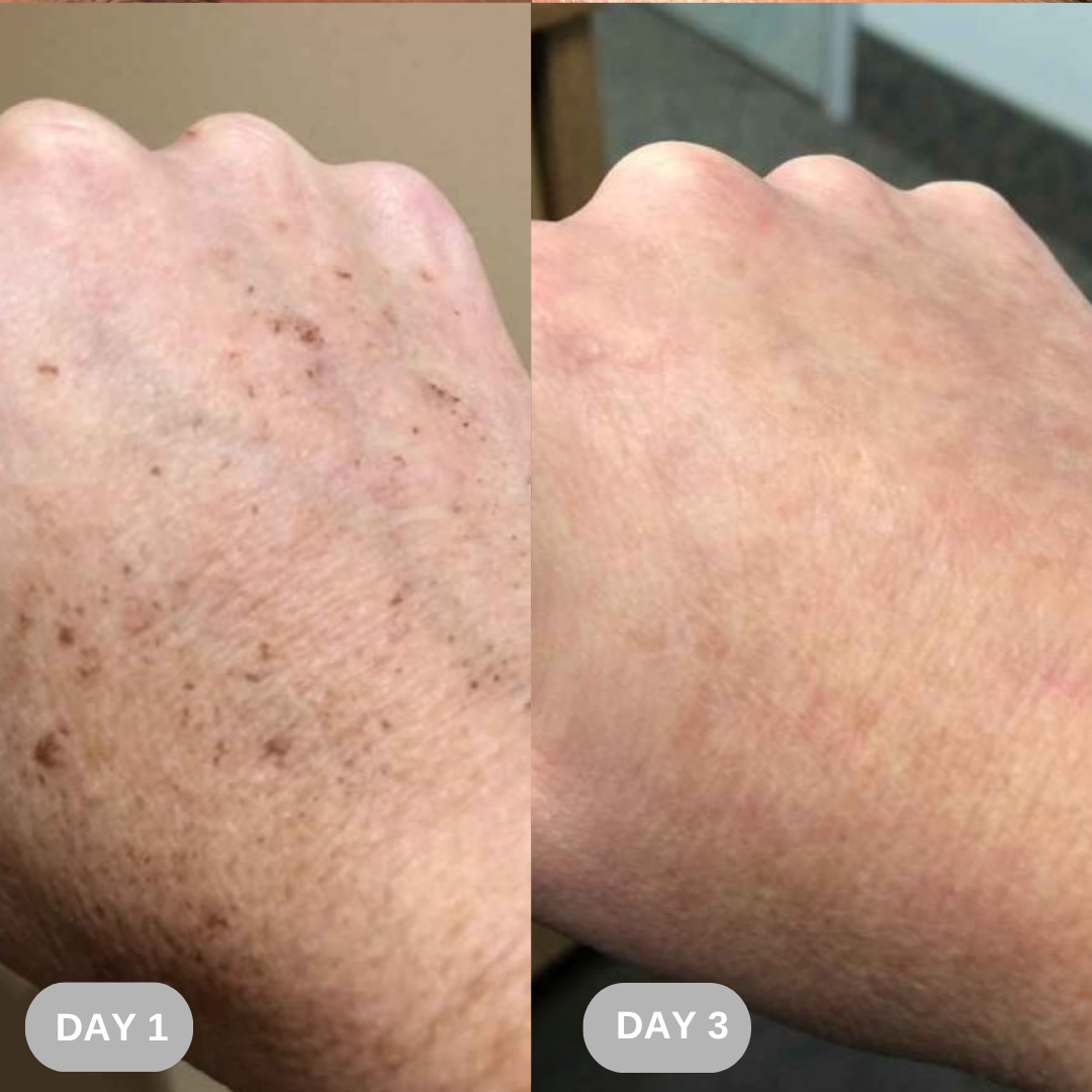 Comparison of a hand on Day 1 and Day 3 showing skin improvement.