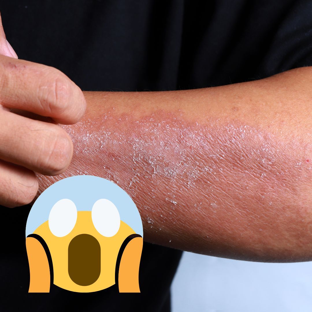 Close-up of a forearm with dry, flaky skin and a shocked emoji overlay.