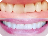 Before and after image of teeth whitening.
