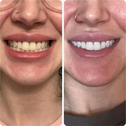 Before and after comparison of teeth whitening results.