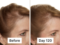 Before and after photos of a woman's hairline, showing increased hair fullness and density after 120 days.