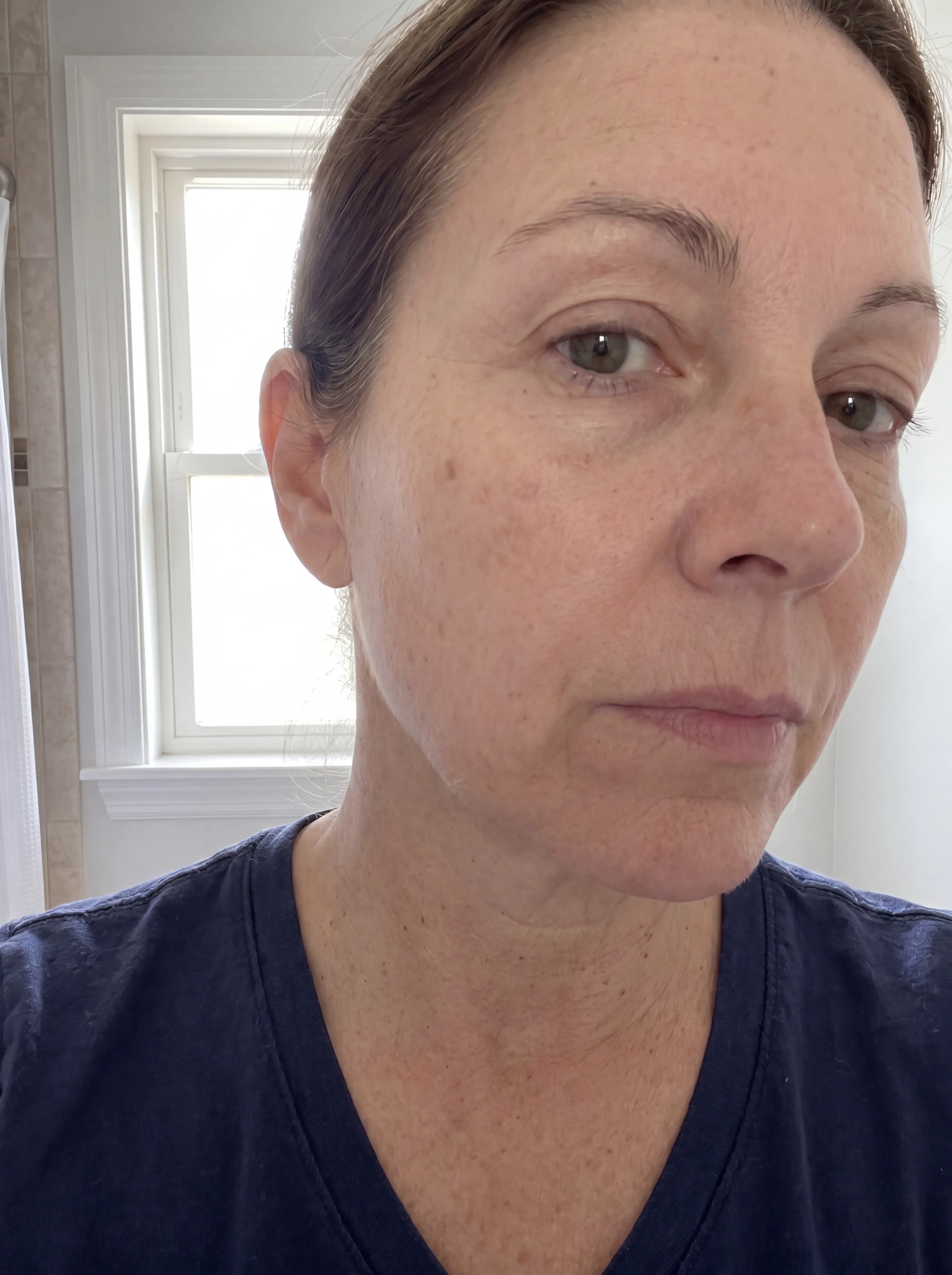 Rachel, after 12 weeks of Dark Spot Corrector Serum