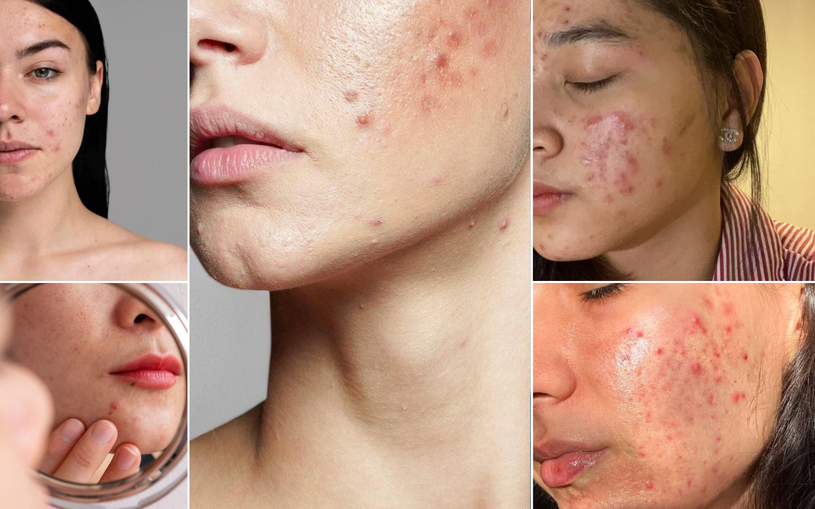 Various close-up images of faces with acne and blemishes.