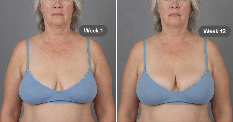 A side-by-side comparison showing a woman's chest at Week 1 and Week 12.
