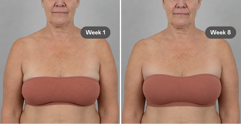 A before and after image showing a woman's chest and neck at Week 1 and Week 8.