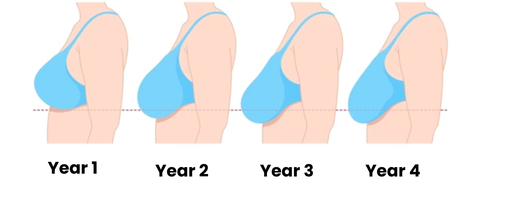 Side profile illustrations showing breast changes over four years.