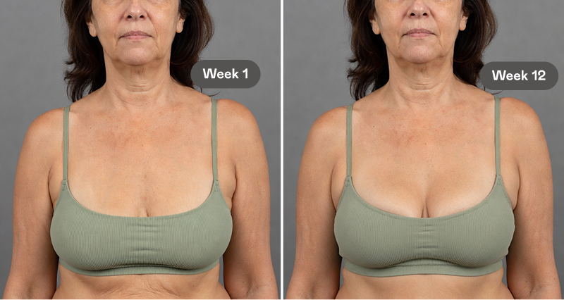 Before-and-after photos of a woman's neck and chest, labeled Week 1 and Week 12.