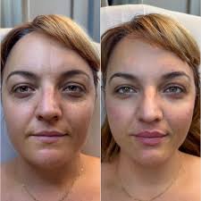 A side-by-side before and after comparison of a woman's face, showing results from a cosmetic procedure.