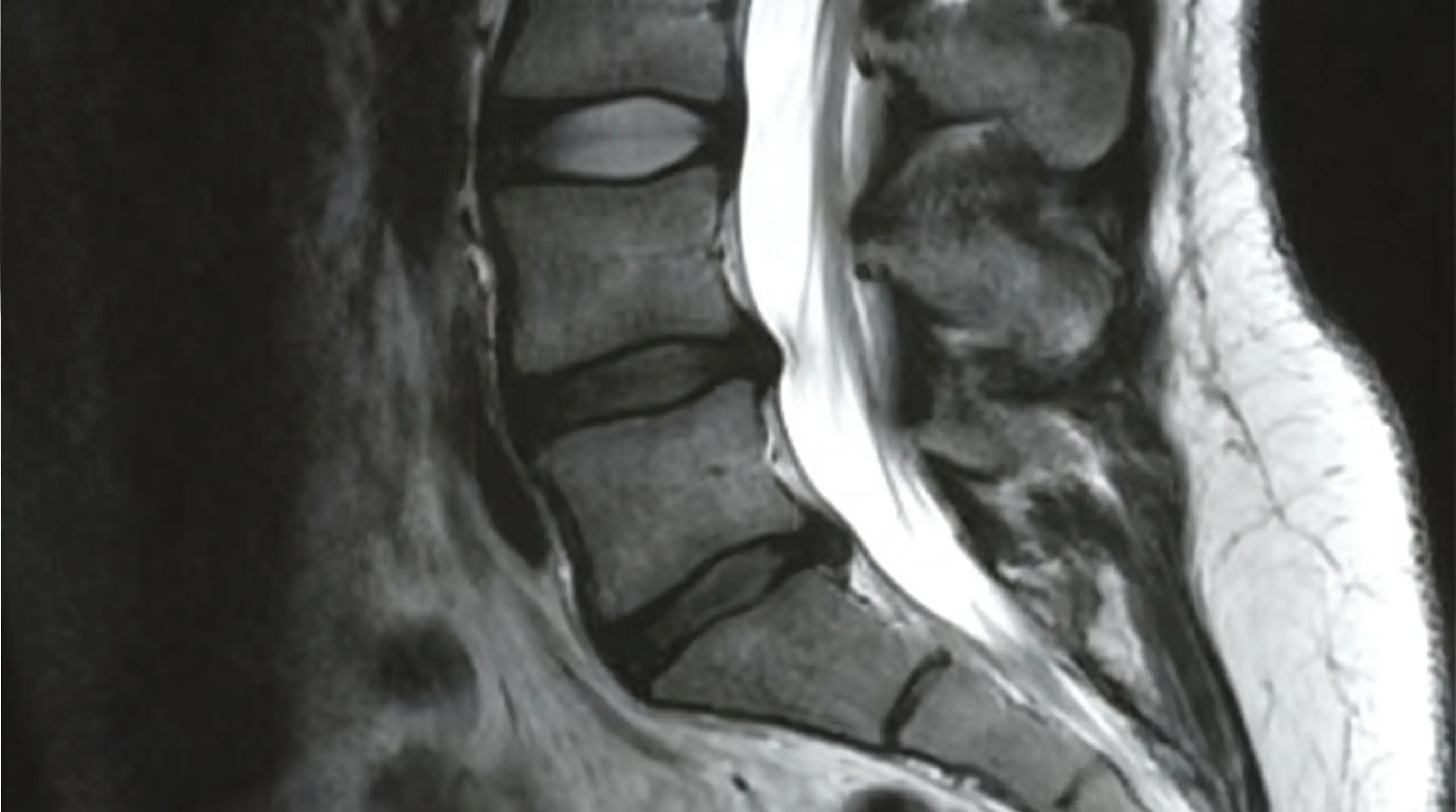 A black and white sagittal view MRI of a human lumbar spine.
