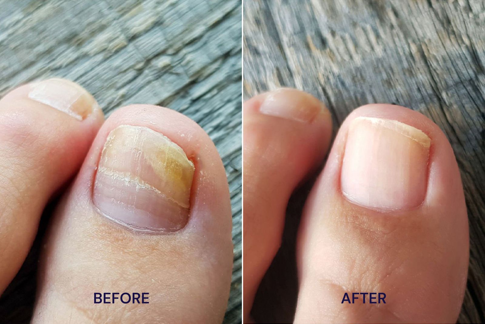 Side-by-side comparison of toenails labeled 'Before' and 'After' treatment.