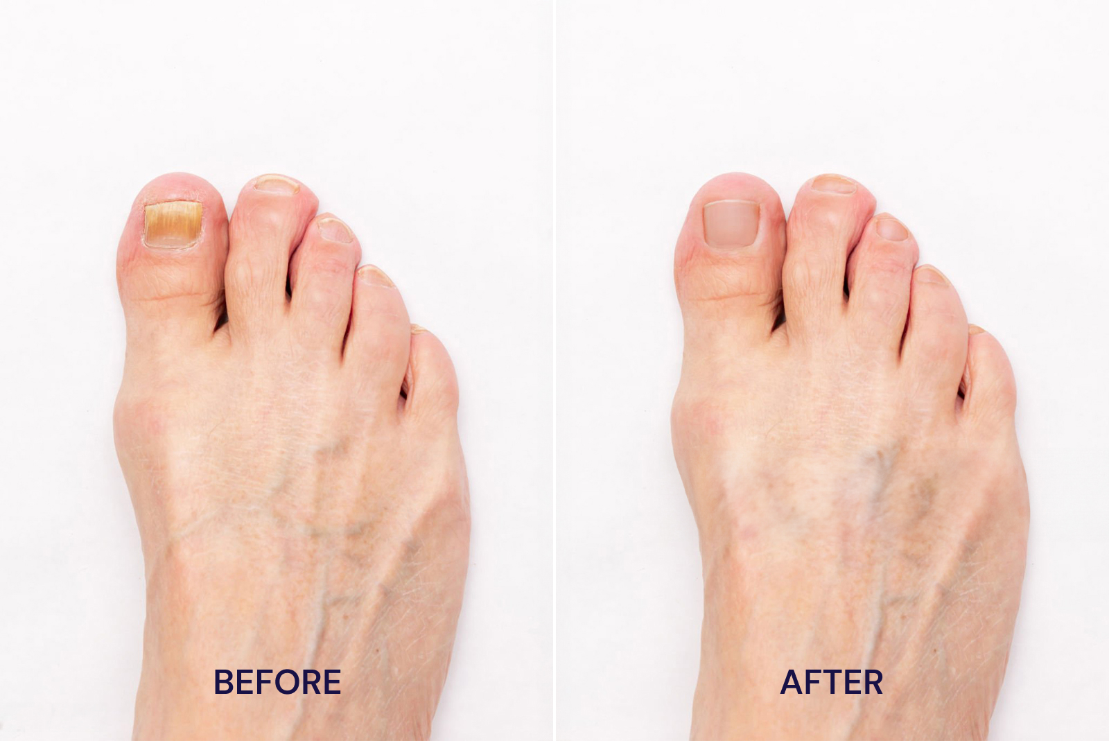Comparison of toenails before and after treatment.