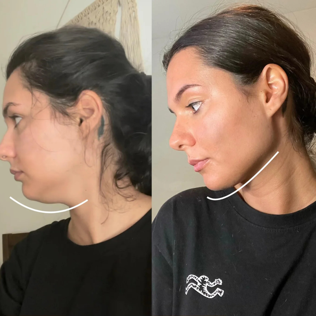 A side-by-side comparison of a woman's profile, before and after, showing a more defined jawline.
