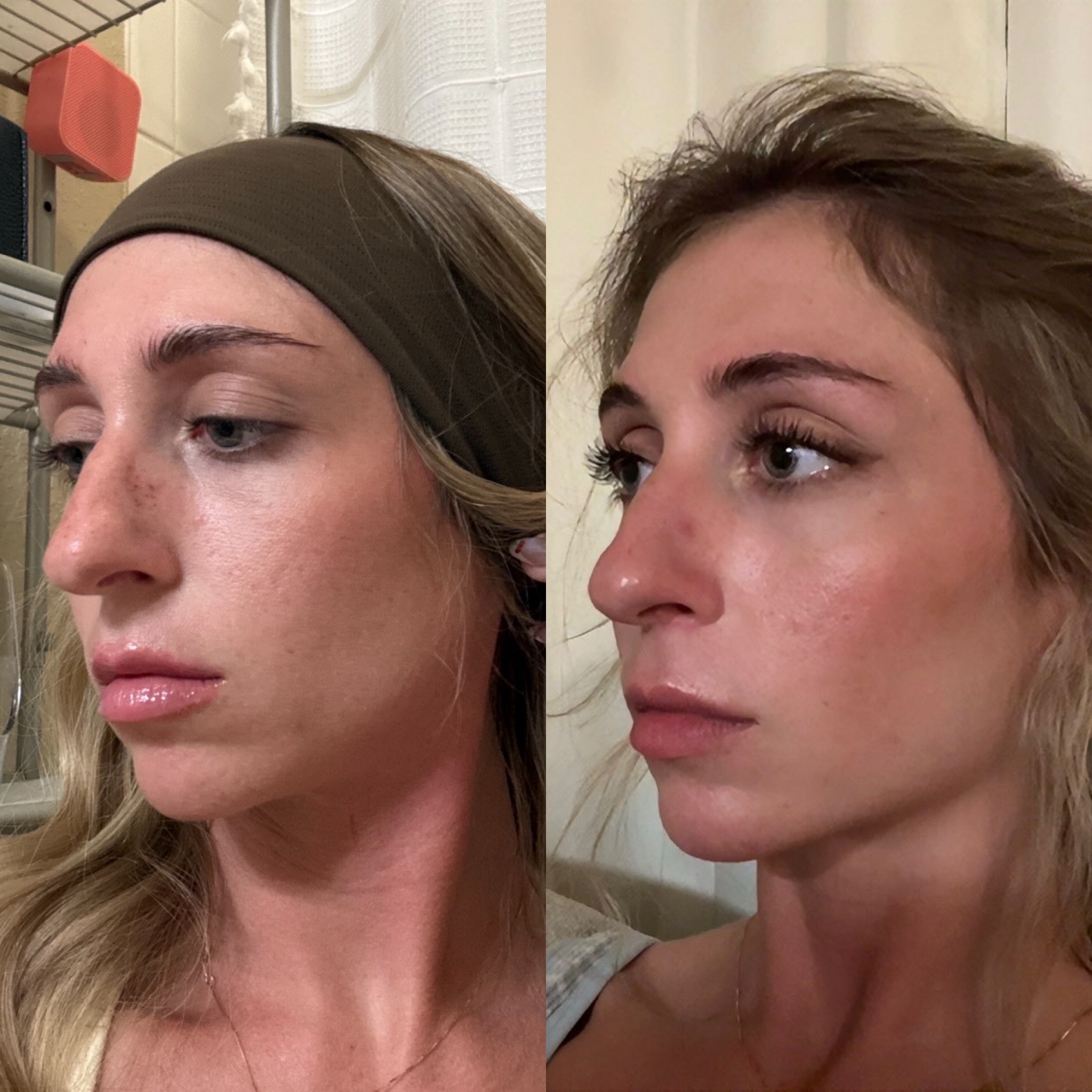 A before and after comparison of a woman's profile, showing a change in her nose shape.
