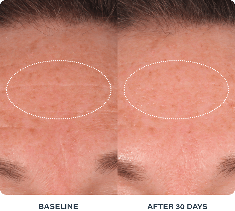 Skin improvement results