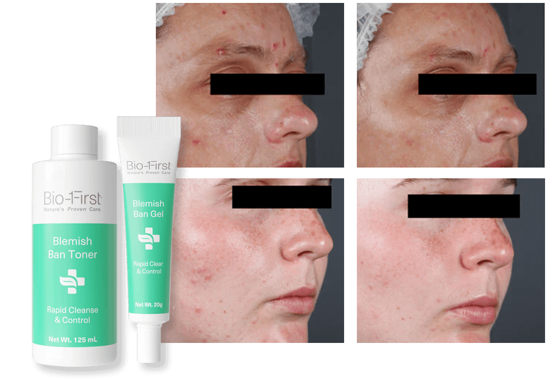 Before-and-after acne treatment with Bio-First Blemish Ban products shown.