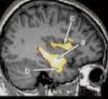 image of a brain scan