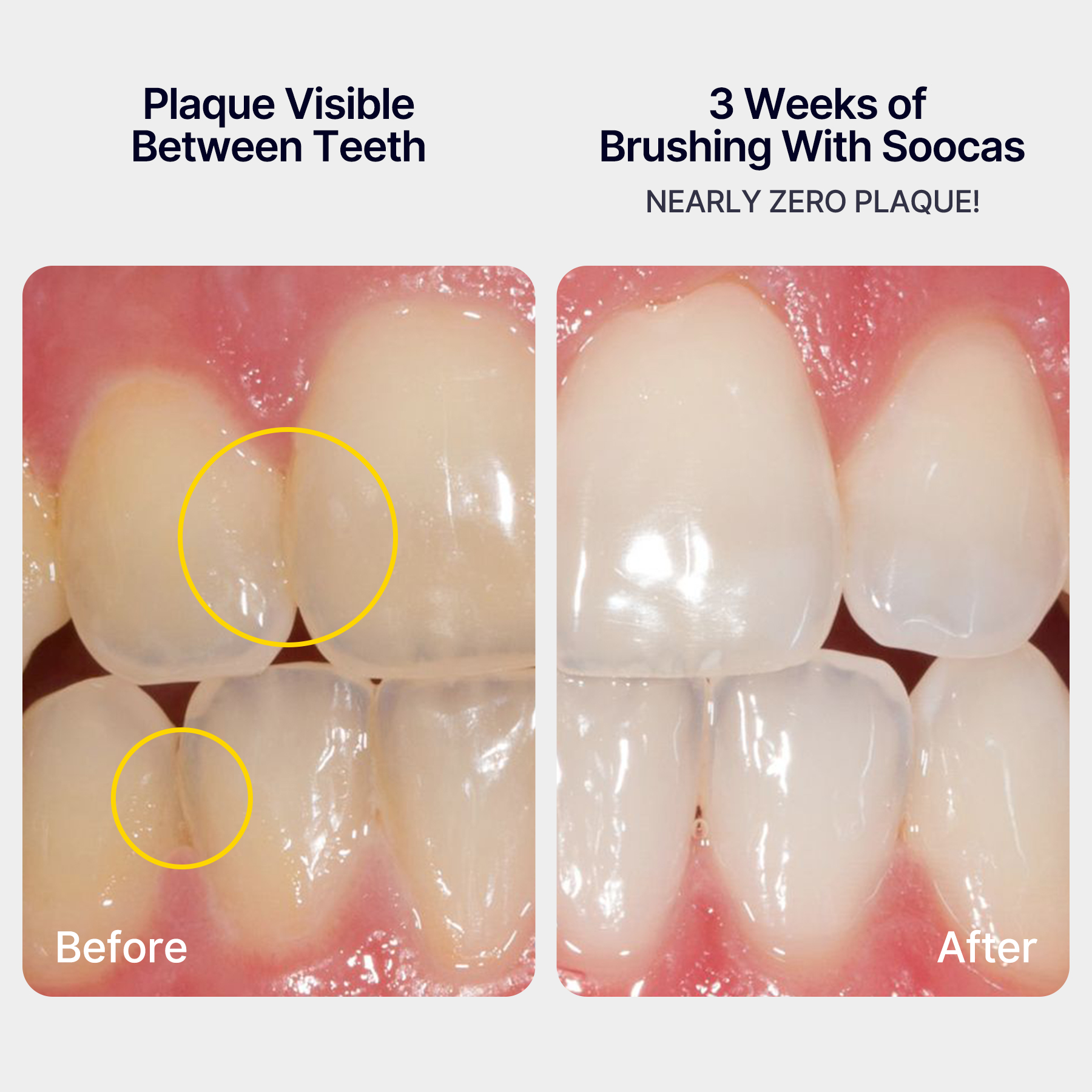 Before and after dental plaque removal comparison.