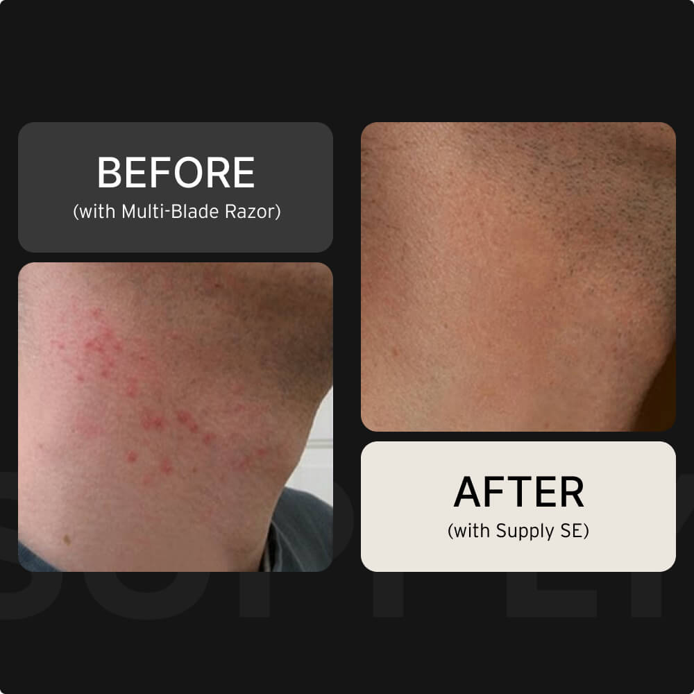 Comparison of neck skin before and after shaving with different razors.