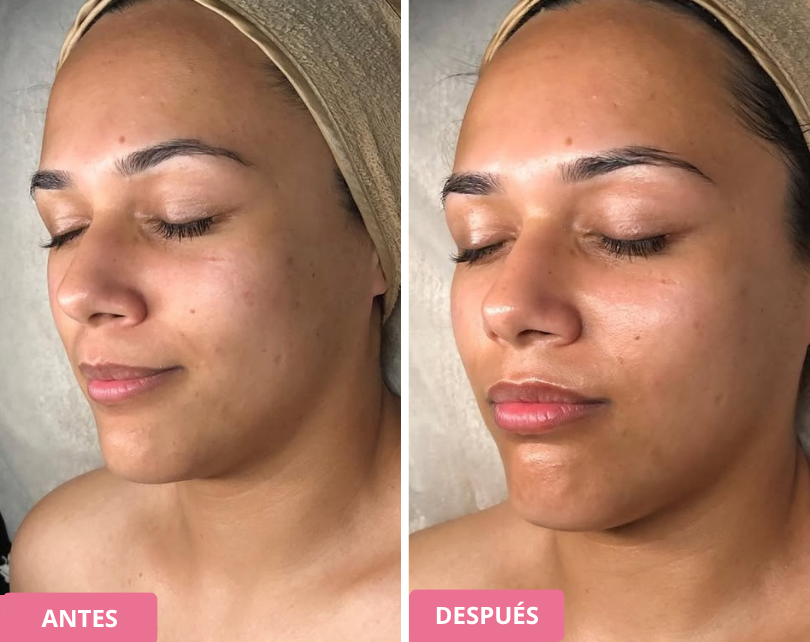 Side-by-side before and after images of a person with smoother skin.