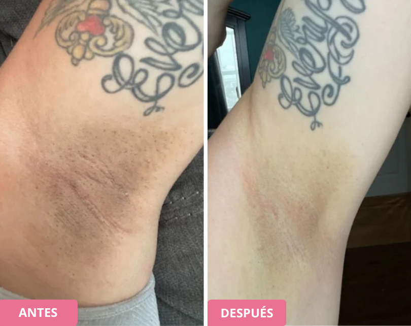 Comparison of tattooed armpit skin tone before and after treatment.