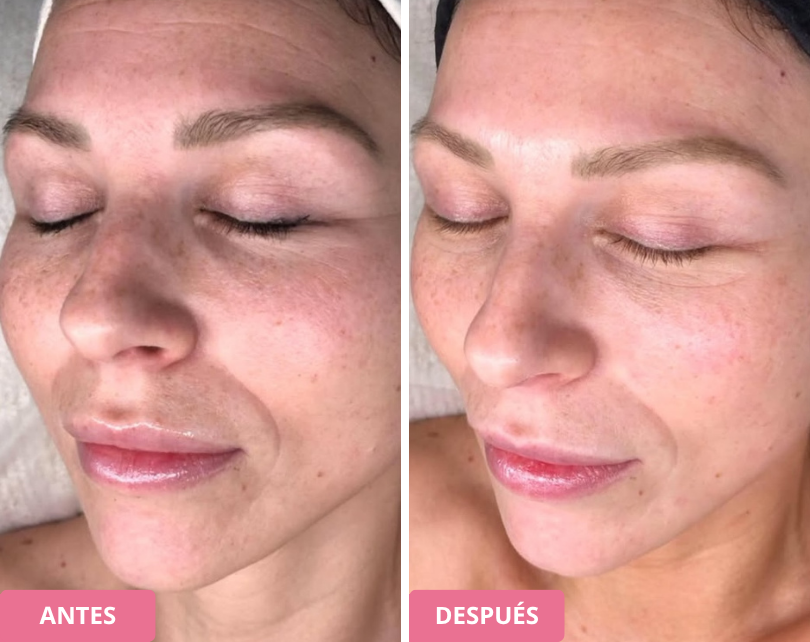 Side-by-side comparison of a woman's face before and after treatment.