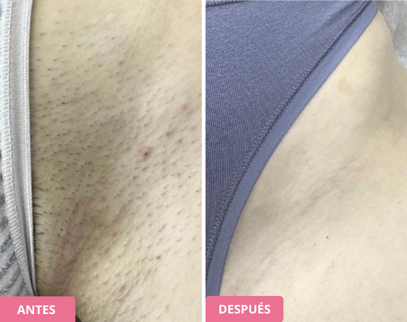 Side-by-side comparison of skin texture before and after treatment, labeled 'Antes' and 'Después'.