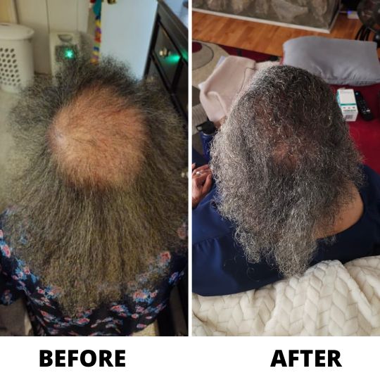 A before and after image showing significant hair regrowth on the crown of a person's head.