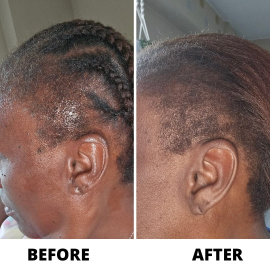 A before and after diptych showing significant hair regrowth on the side of a person's head.