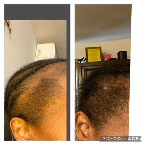 A before-and-after split image showing hair regrowth along a person's hairline and temple.