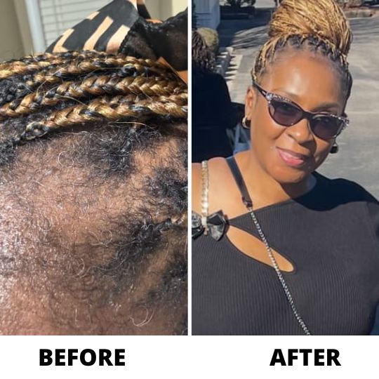 A before and after image showing a woman's hair, from thinning to a full head of braids.
