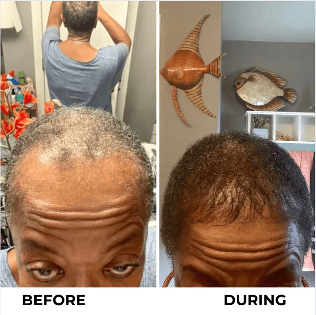 A before and during comparison showing new hair growth on a woman's hairline and scalp.