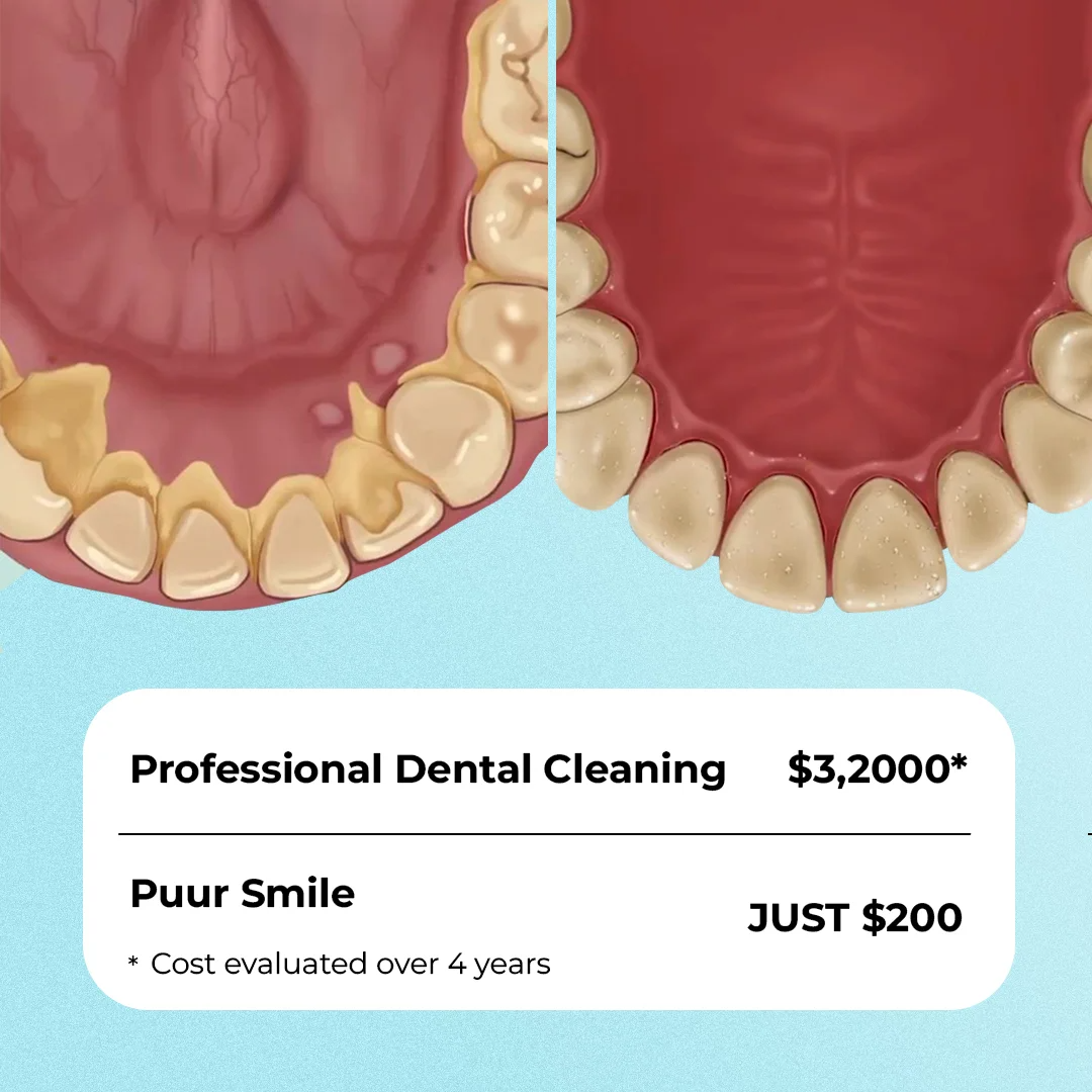 Comparison of teeth before and after dental cleaning with cost details.