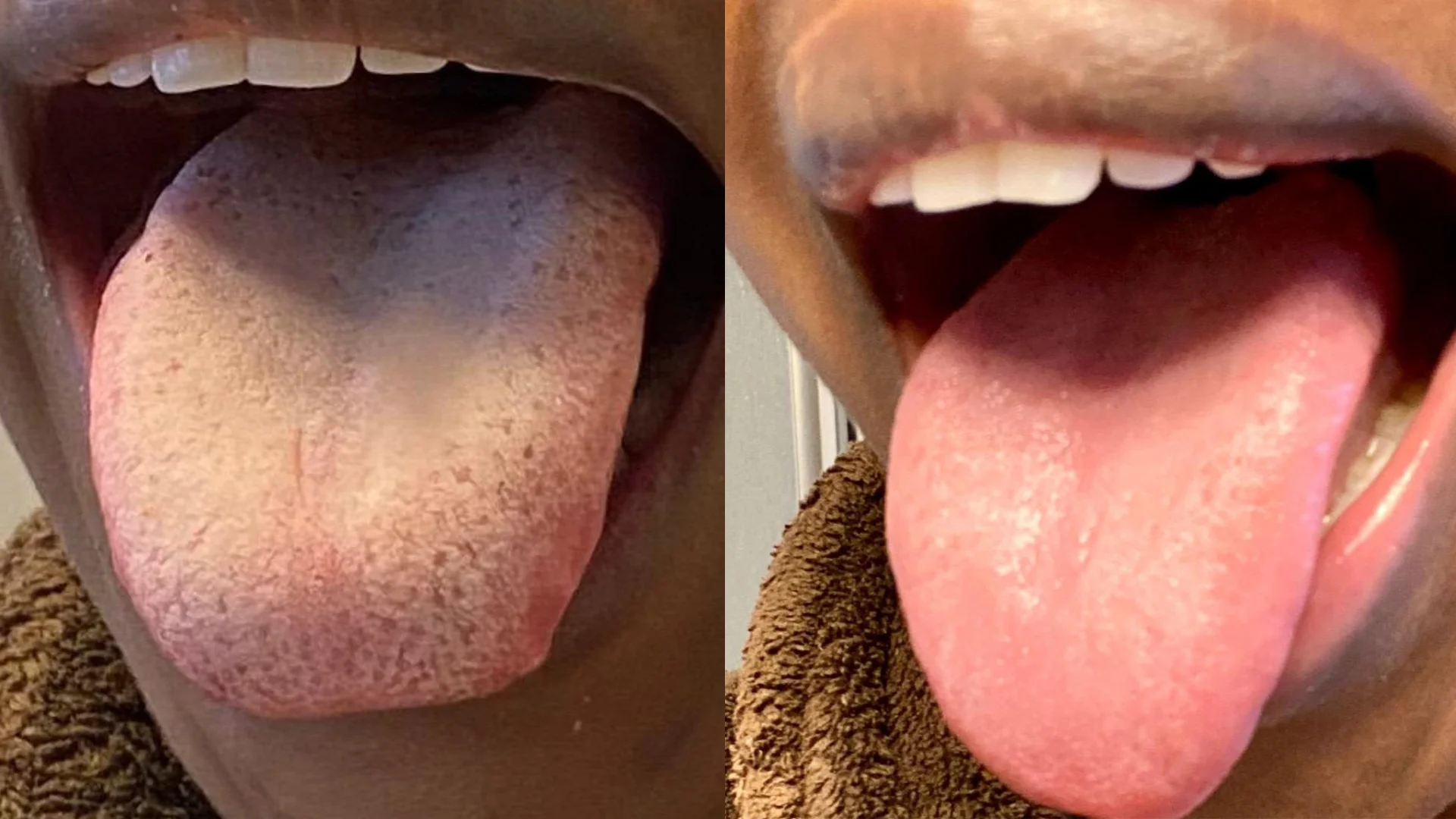 Two close-up images of a person's tongue, one dry and one moist.