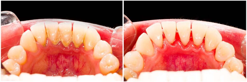 Comparison of teeth and gums before and after dental treatment.