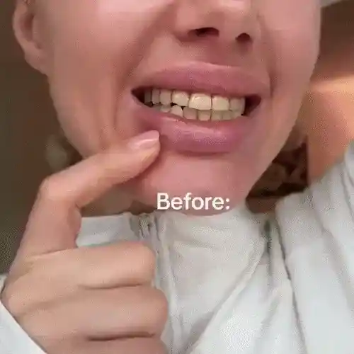 Person showing teeth with the word 'Before' overlaid.