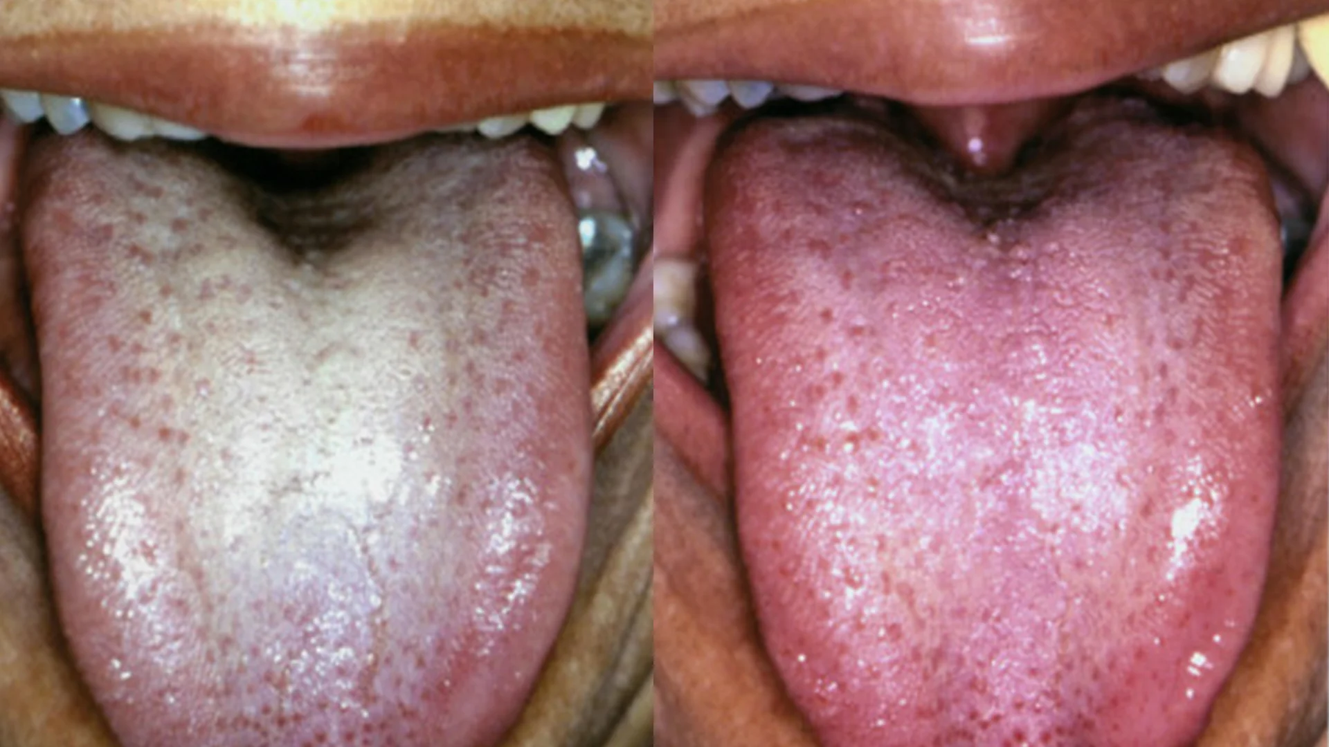 Side-by-side comparison of two tongues with different textures and colors.