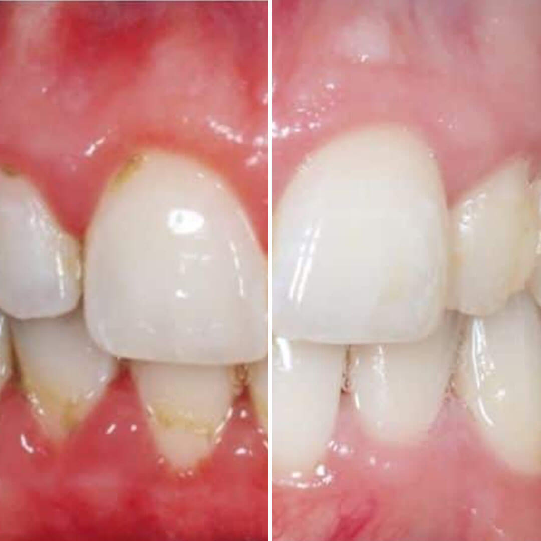 Comparison of teeth before and after cleaning, showing reduced plaque and whiter appearance.