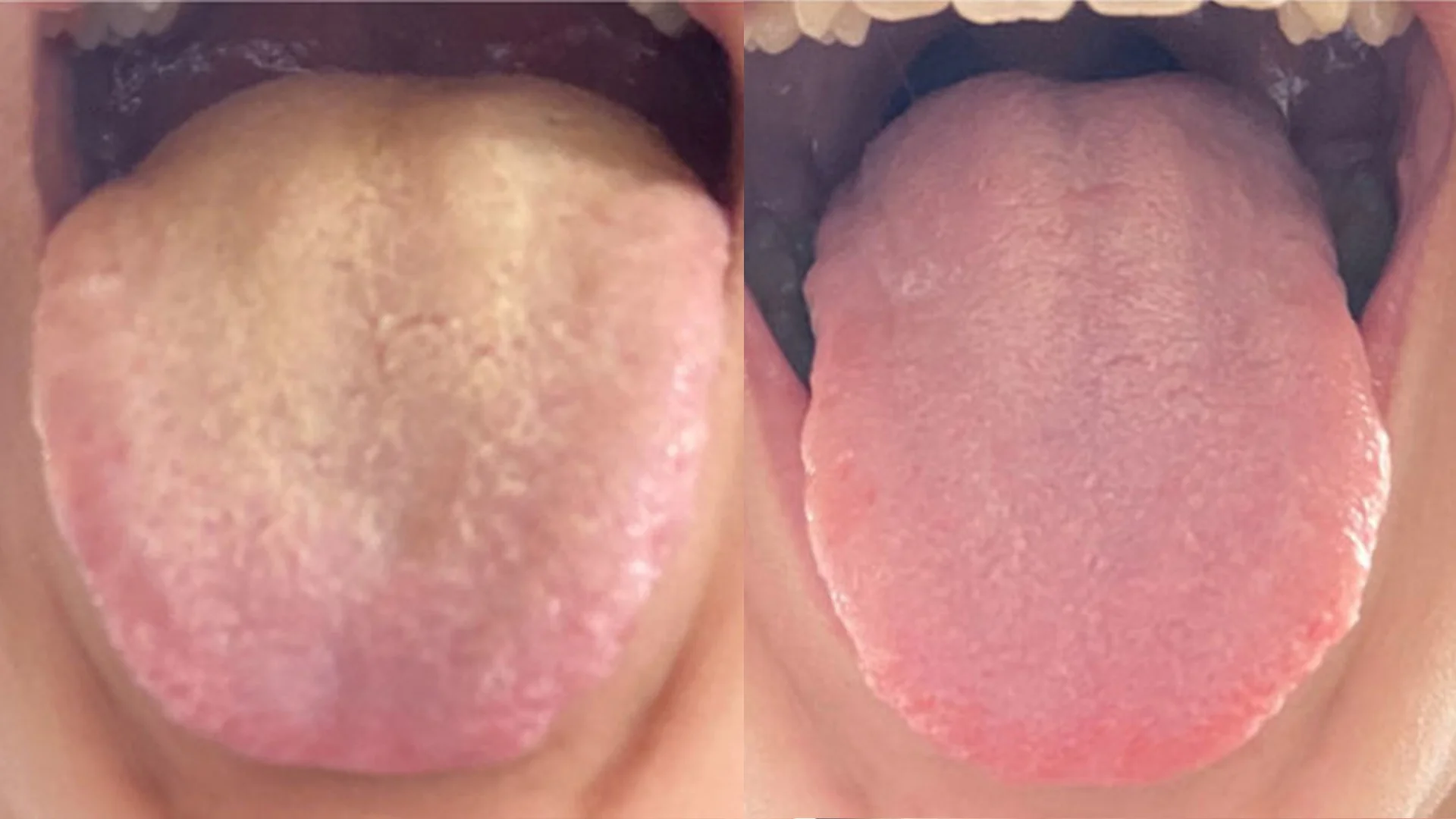 Side-by-side comparison of two tongues, one discolored and one pink.