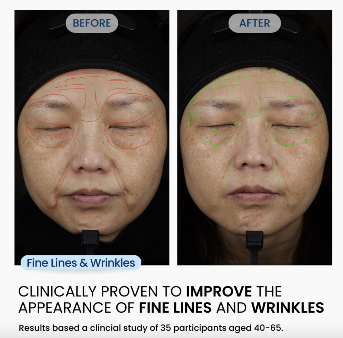 Before and after image showcasing fine lines and wrinkles