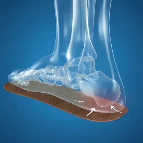 Illustration of a transparent foot on an orthopedic insole with arrows indicating pressure points.