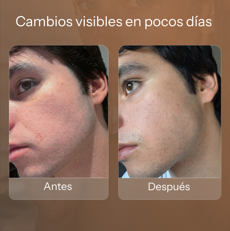 Before and after images of a man's face showing a significant reduction in acne and skin blemishes.